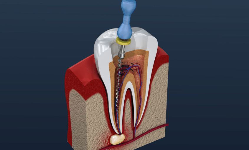 Endodoncia Anterior