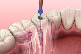 Endodoncia (Tratamiento de conducto) en Premolares